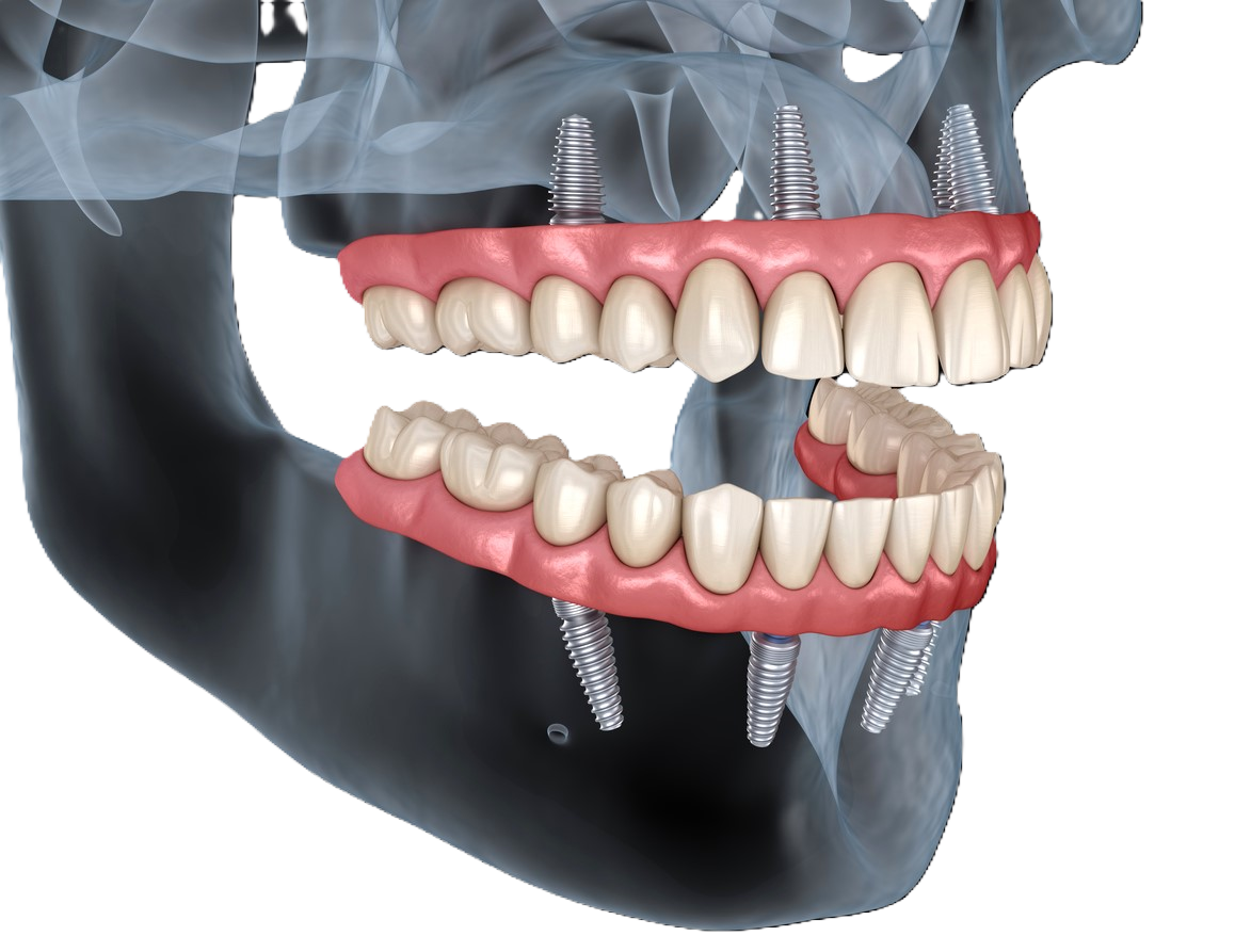 Illustration of full mouth dental implants